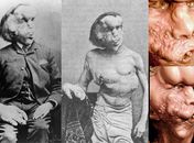 Conheça a história do Homem Elefante