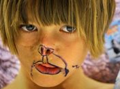 Médicos reconstruirão face de menina atacada por guaxinim