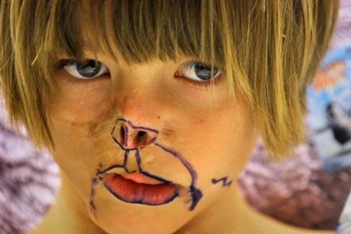 Médicos reconstruirão face de menina atacada por guaxinim