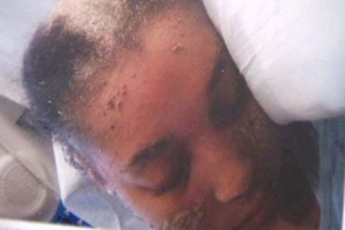 Mulher sofre de doença que faz crescer unhas em vez de cabelos e pelos