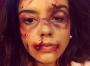 Giovanna Lancellotti posta foto com o rosto cheio de hematomas