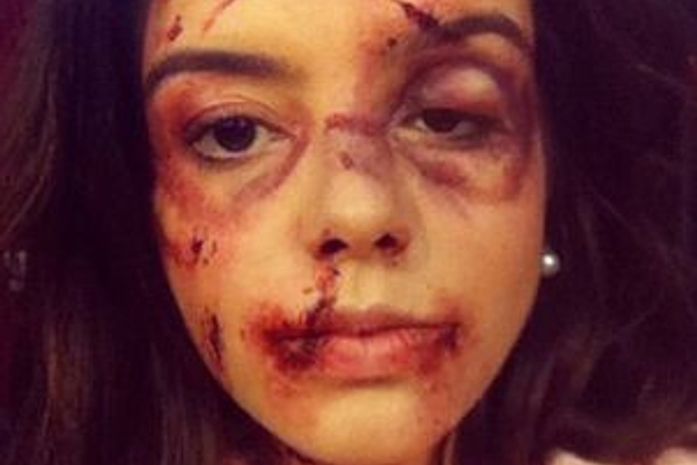 Giovanna Lancellotti posta foto com o rosto cheio de hematomas