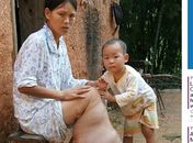 Sem dinheiro para tratar, chinesa com "perna de elefante" quer amputar