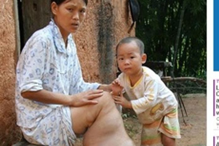Sem dinheiro para tratar, chinesa com "perna de elefante" quer amputar