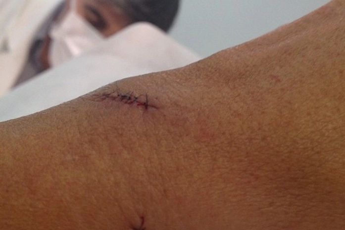 Regina Casé toma pontos após se machucar durante o banho