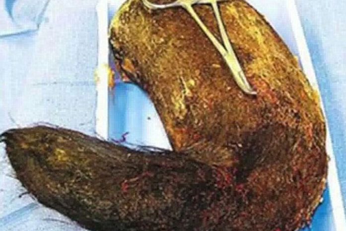 Médicos removeram cerca de 1,8 quilo de cabelos do estômago de jovem de 19 anos.