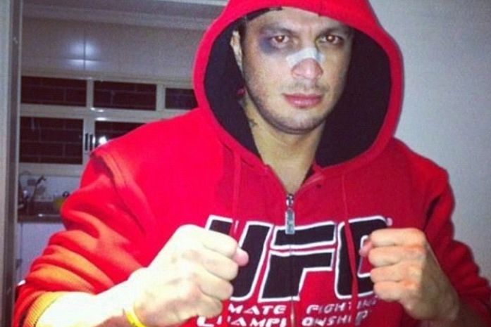 Ex-BBB Kleber Bambam posa de olho roxo e curativo no nariz