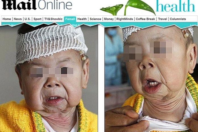 Chinesa de 1 ano sofre de doença rara de pele que a faz parecer idosa