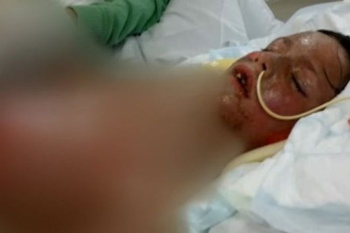 Menino que perdeu 65% da pele em reação alérgica se diz ‘feliz por ter sobrevivido’