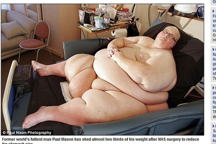 Maior obeso do mundo emagrece e precisa tirar 50 kg de pele em cirurgia