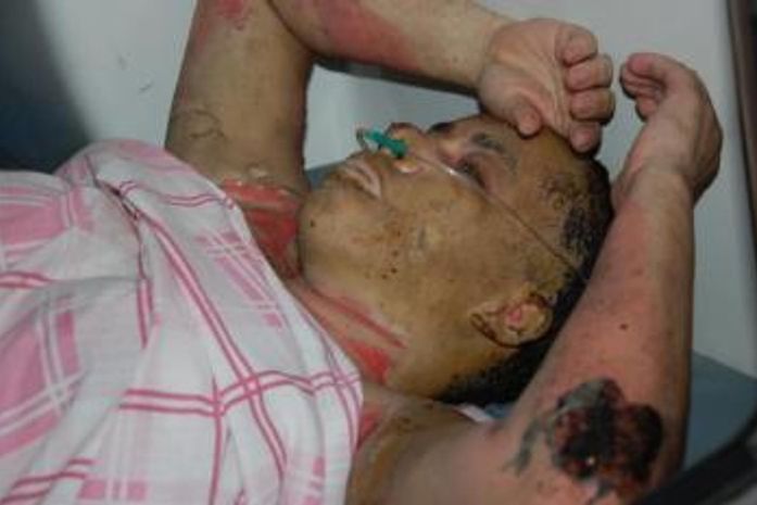 Mulher ateia fogo em seu próprio corpo em Marechal Deodoro