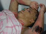 Mulher que ateou fogo em seu corpo morre