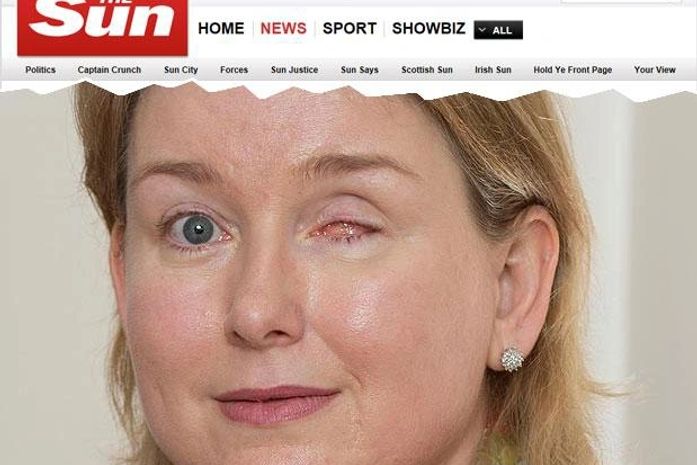 Britânica afirma que problema foi causado por uma lente de contato