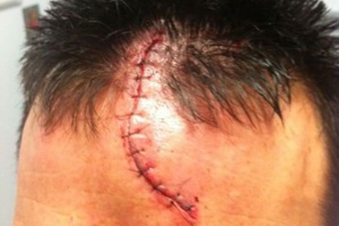 Jogador de rúgbi toma pancada, leva 18 pontos na testa e vira 'Frankenstein'