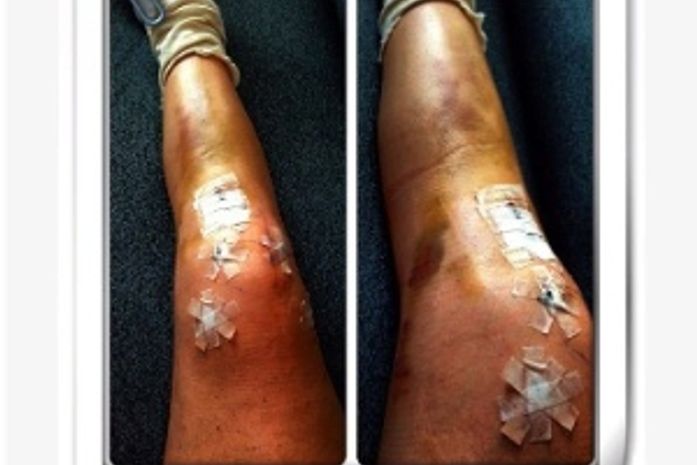 Musa do esqui mostra marcas de grave acidente