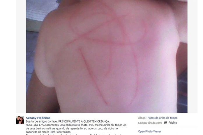 Mãe alega que vidro em sabonete infantil machucou seu filho