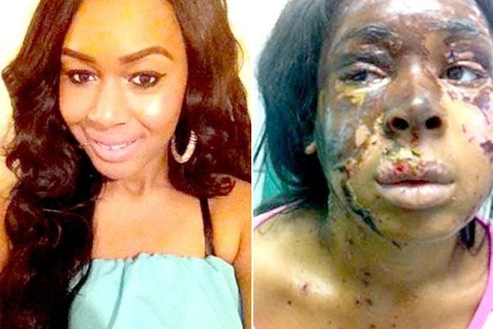 Polícia prende dois acusados de ataque com ácido no Reino Unido