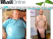 Após emagrecer 82 kg, homem sofre com excesso de pele até o joelho