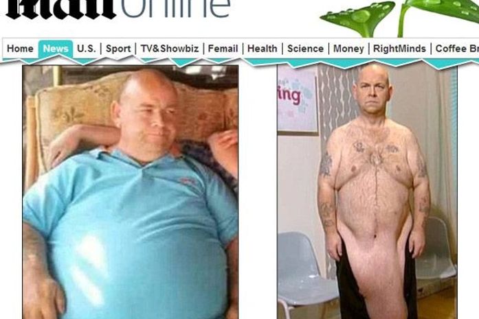 Após emagrecer 82 kg, homem sofre com excesso de pele até o joelho