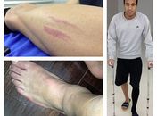 De muletas, Lucas mostra tornozelo inchado e diz estar bem