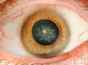 Cientistas detectam catarata estrelada em paciente na Áustria