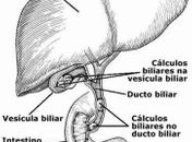 Cálculos biliares não tratados podem levar a sérias complicações clínicas
