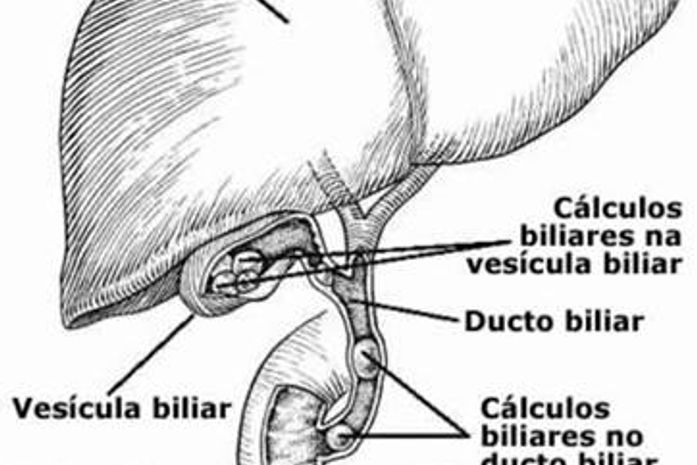 Cálculos biliares não tratados podem levar a sérias complicações clínicas