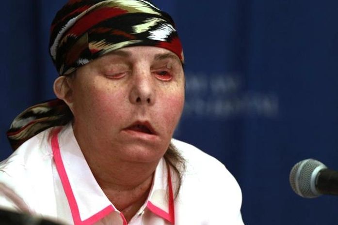 Americana com 80% do corpo queimado mostra nova face após transplante