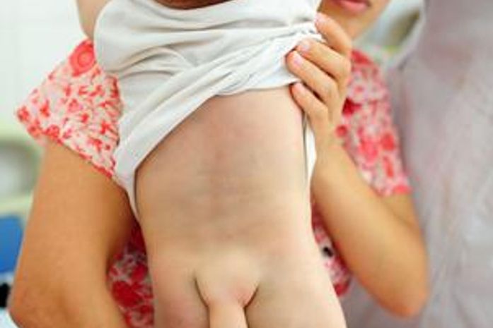 Menino chinês nasceu com uma "cauda". Segundo médicos, protuberância não pode ser retirada com cirurgia - pelo menos, não agora