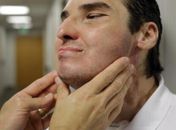 Após reconstrução facial, homem deixa reclusão e leva vida normal