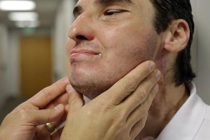 Após reconstrução facial, homem deixa reclusão e leva vida normal