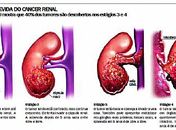 Cirurgia ainda é a única alternativa de cura para o carcinoma renal