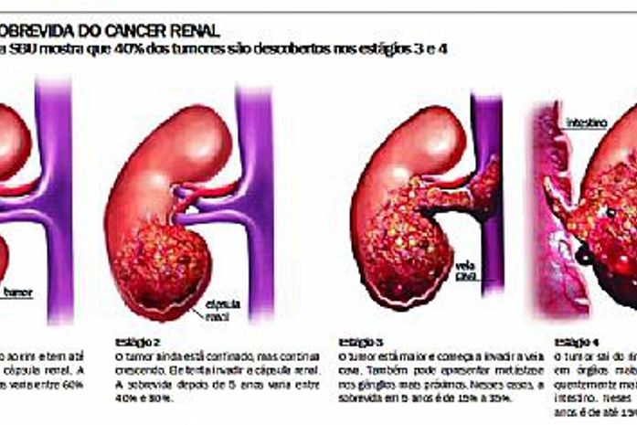 Cirurgia ainda é a única alternativa de cura para o carcinoma renal