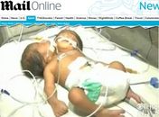 Índia registra nascimento raro de gêmeos ligados pelo corpo