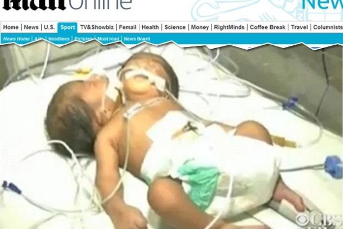 Índia registra nascimento raro de gêmeos ligados pelo corpo