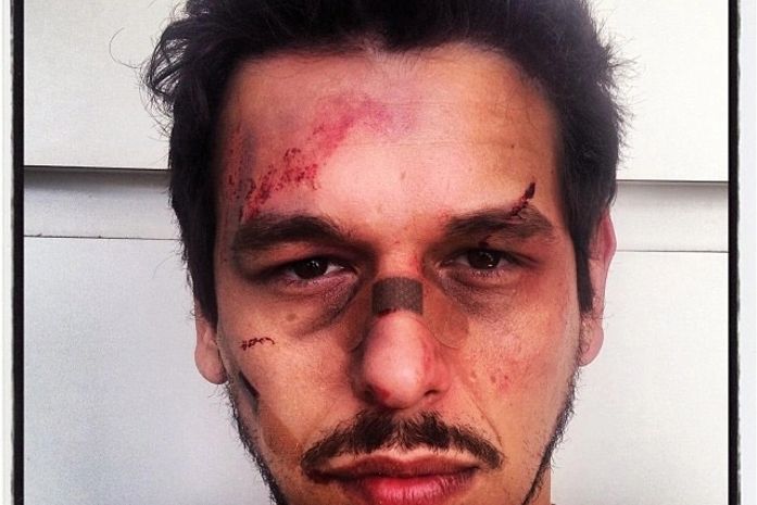 Lascado! Namorado de Sabrina Sato, João Vicente aparece com a cara toda machucada