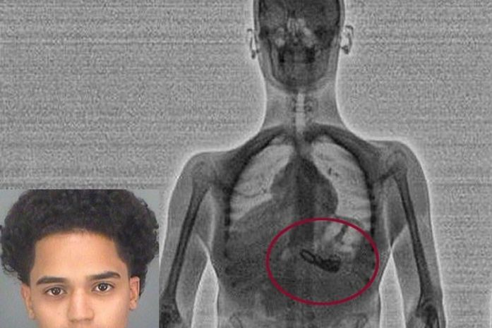 Ladrão engole joias para evitar prova, mas é flagrado no scanner corporal