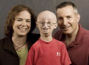 Com doença rara, americano morre aos 17 anos de "velhice"
