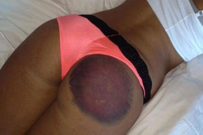 Modelo sofre hematoma no bumbum em torneio de golfe