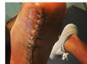 Após cirurgia, goleiro Hélton exibe cicatriz impressionante