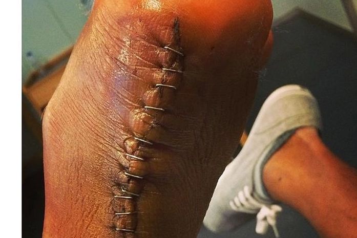 Após cirurgia, goleiro Hélton exibe cicatriz impressionante