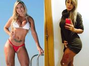 Andressa Urach faz cirurgia para tirar produto que engrossava suas coxas