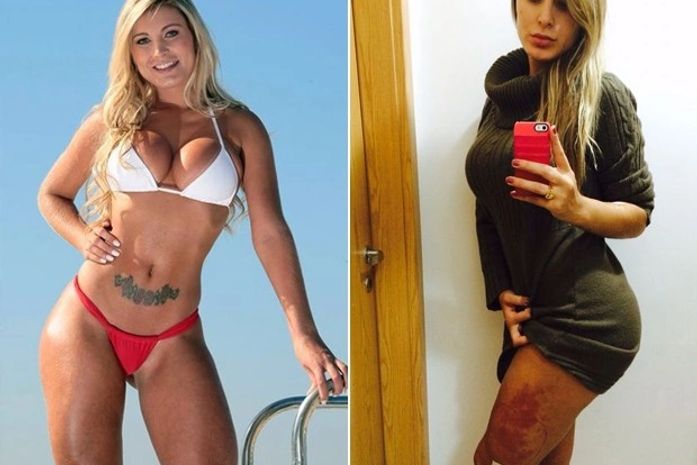Andressa Urach faz cirurgia para tirar produto que engrossava suas coxas