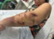 Turista de Brasília sofre ataque de cães em Paripueira e segue hospitalizada em Maceió