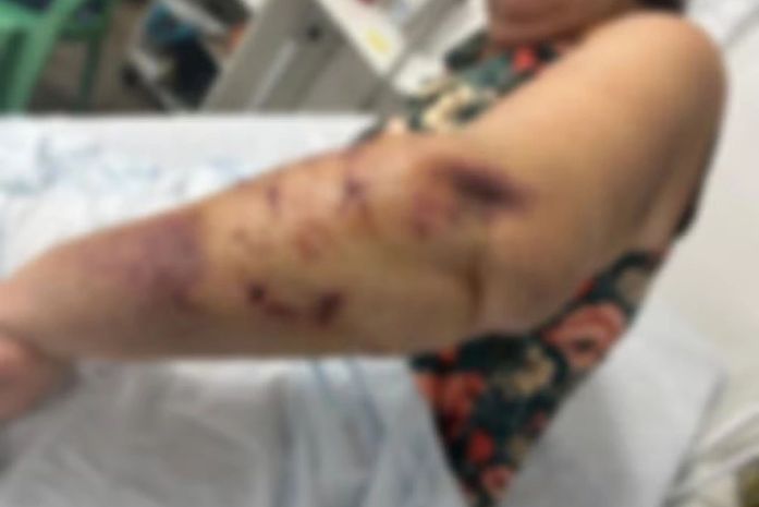 Turista de Brasília sofre ataque de cães em Paripueira e segue hospitalizada em Maceió