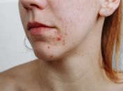Mitos e verdades sobre o uso de Roacutan para tratar acne