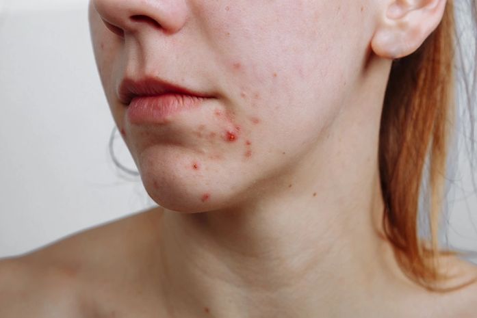 Mitos e verdades sobre o uso de Roacutan para tratar acne