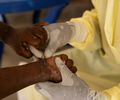 Brasil registra 88 casos de Mpox em 2026; saiba como evitar a doença