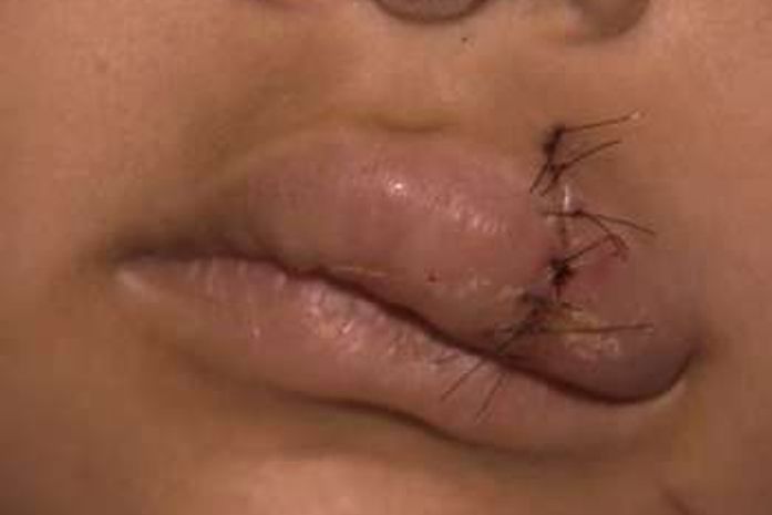 Parte do lábio da esposa foi arrancado após mordida