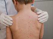 Meningite